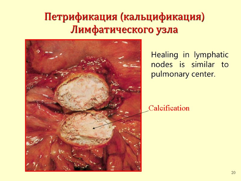 Петрификация (кальцификация) Лимфатического узла Healing in lymphatic nodes is similar to pulmonary center. 